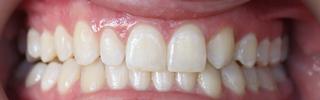 a smile without gaps | invisalign vienna va