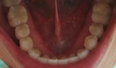 a top down view of a patients lower teeth after receiving invisalign | invisalign dentist vienna va