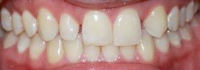 a smile with gaps on the sides of the front teeth | invisalign dentist vienna va