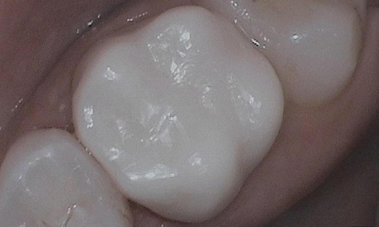molar restored with CEREC crown | cerec crowns in vienna va
