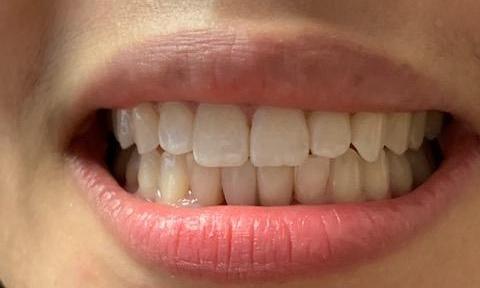 Vienna dental patient after implant bridge at Tysons Dentistry