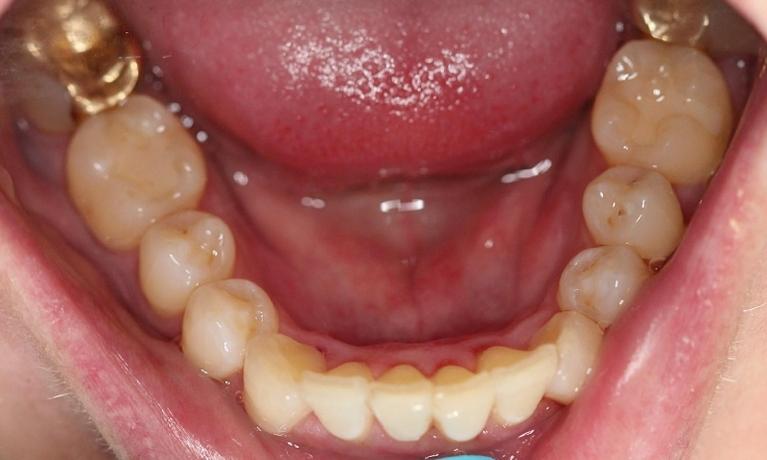 aligned lower teeth after an invisalign treatment | dentist invisalign vienna