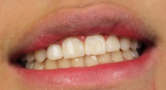 dental veneers | veneers | vienna va