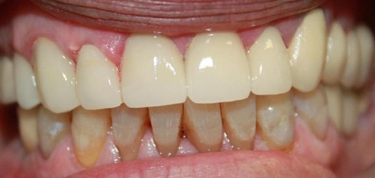 teeth after teeth whitening and with new porcelain crowns | vienna va dentist
