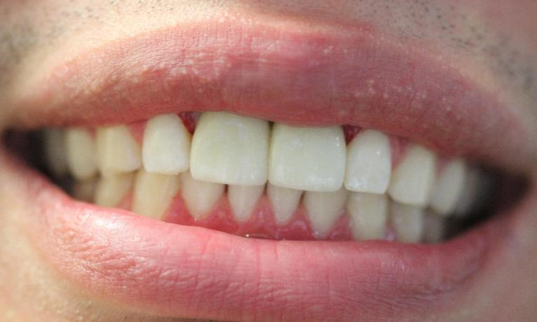 two new front teeth, created by crowns for the dental implant posts | dental implants vienna va