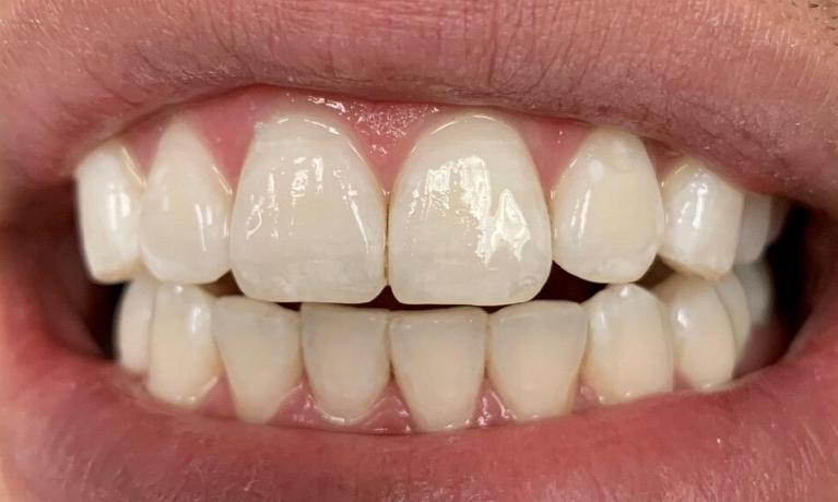 teeth whitening | vienna va