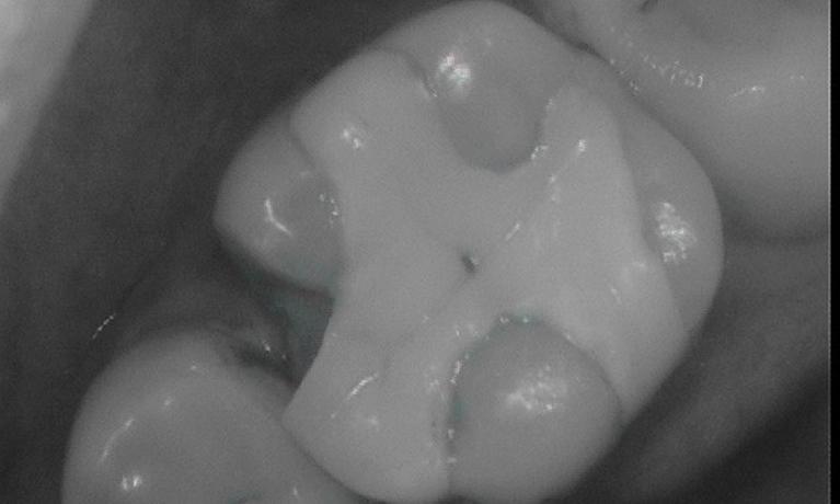 fractured molar with old, large filling | Cerec dentist in vienna