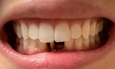 Tysons dentistry patient before implant bridge