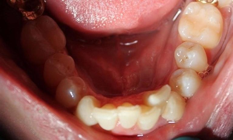 crowded lower teeth before an invisalign treatment | invisalign dentist in vienna va