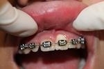 dental veneers | veneers | vienna va