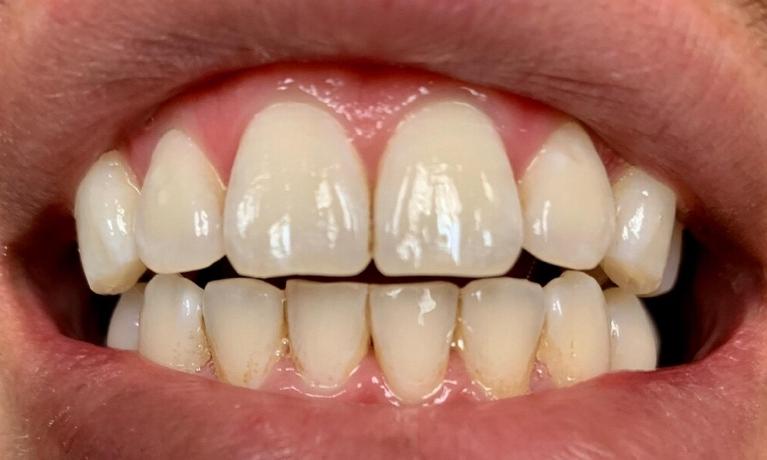 teeth whitening | vienna va