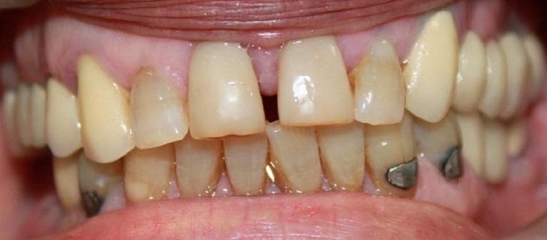 teeth before teeth whitening and porcelain crowns | dentist in vienna va