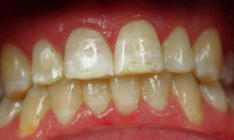 teeth with white spots | dentist in vienna