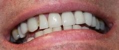 ddental veneers | vienna va | tysons dentistry