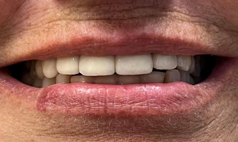 implants in Vienna- After Photo
