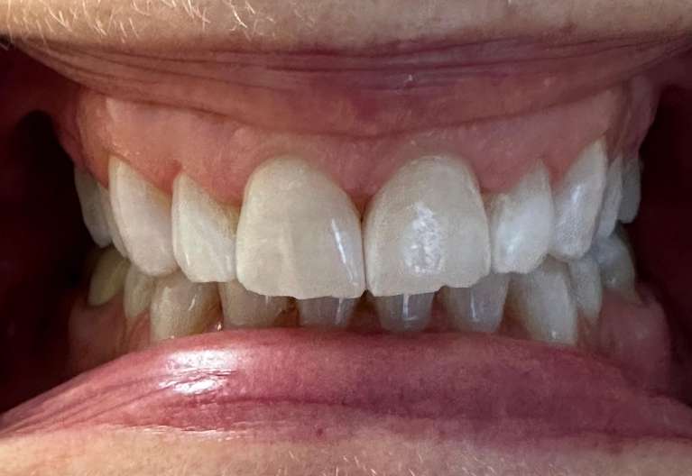 Teeth whitening in Vienna- After Photo